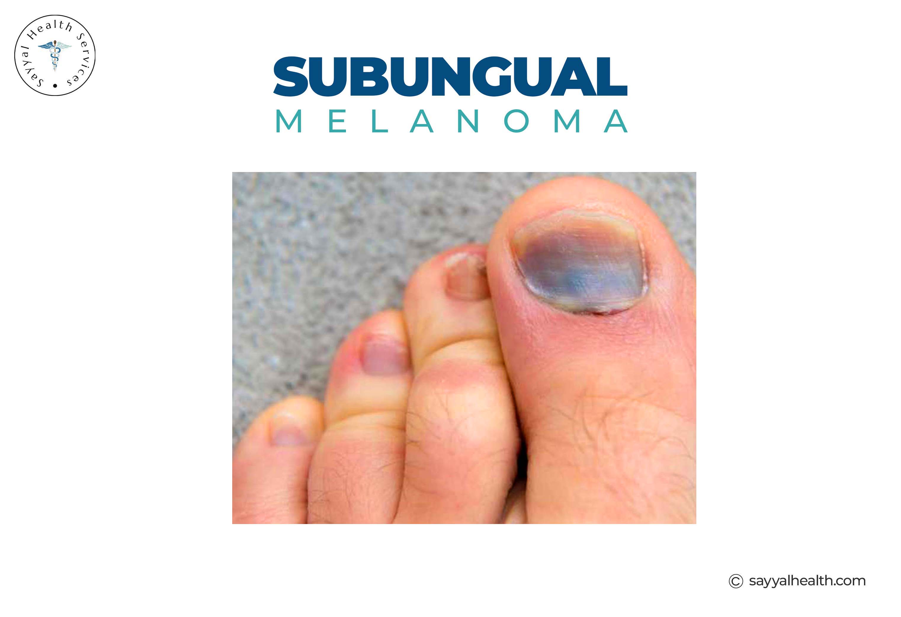 Subungual Melanoma